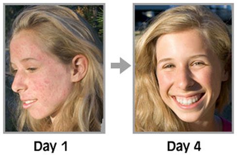 acne free in 3 days